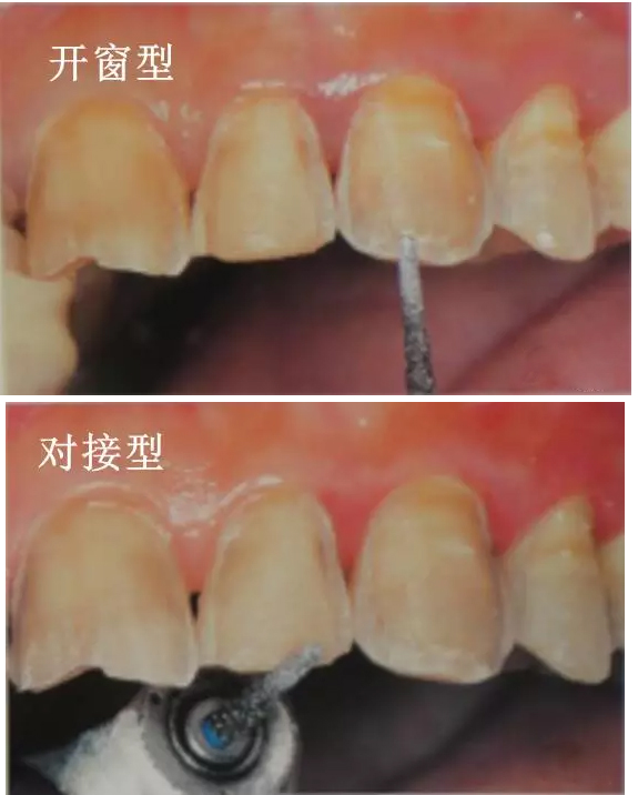 瓷贴面牙体预备的原则与步骤